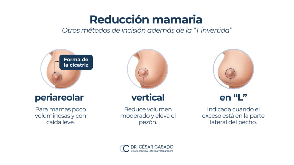 Reducción mamaria tipos de incisión periolar vertical en L
