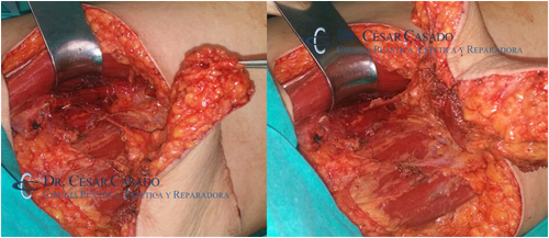 Detalle de disección de colgajo musculocutáneo de gracilis para reconstrucción mamaria