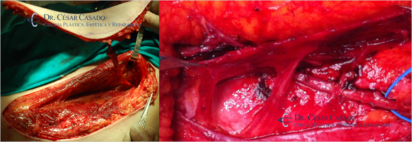 Detalle de disección de colgajos ALT y DIEP, con preservación de ramas motoras y mínima lesión muscular