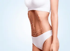 Mujer muestra su abdomen esculpido después de una lipoescultura, destacando la definición y armonía corporal lograda en Madrid.