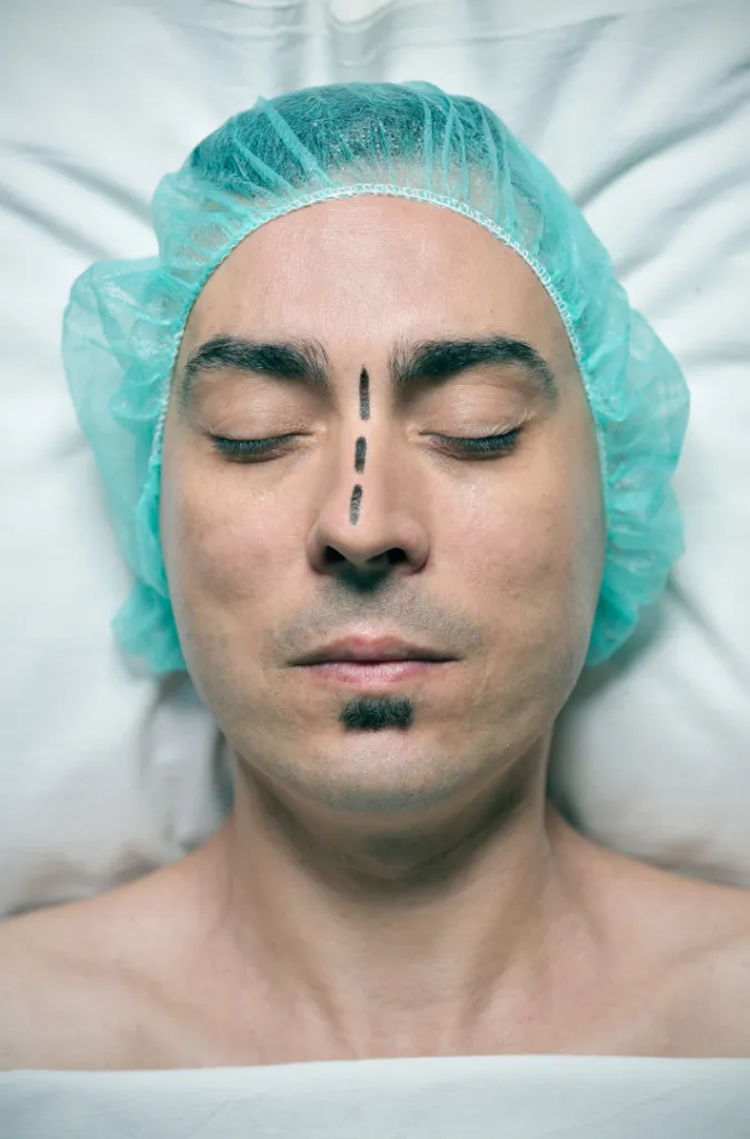 rinoplastia para hombre en madrid
