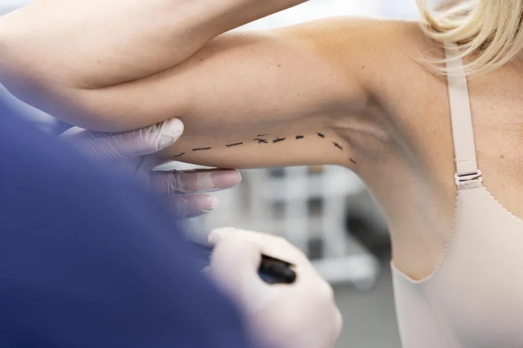 Lifting de brazos (braquioplastia): mejora del contorno y reducción de flacidez en la cara interna del brazo.